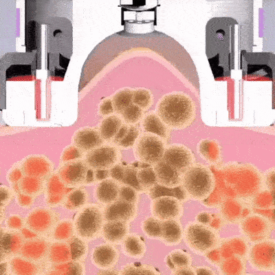 Cupnova 12 levels – anti-cellulite massager